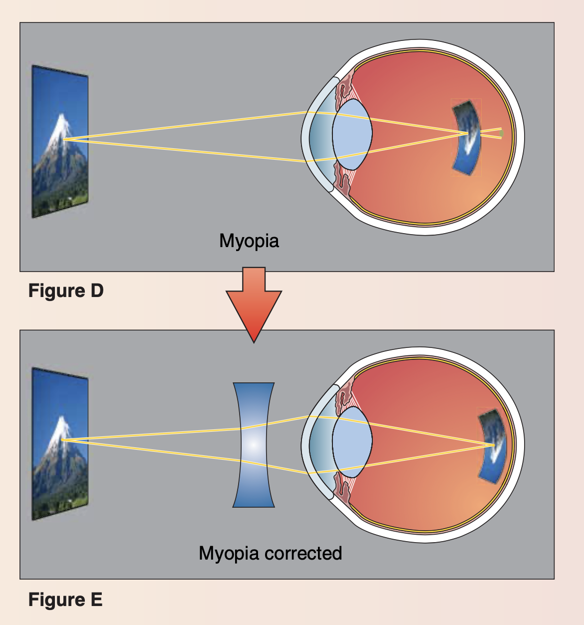 Vision correction